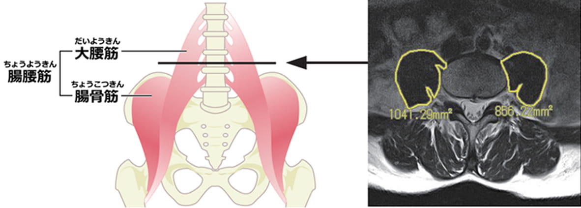 腸腰筋、大腰筋、腸骨筋図解 レントゲン