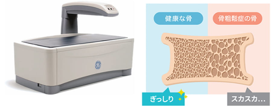 骨密度検査機械 骨密度図解 健康な骨はぎっしり、骨粗鬆症の骨はスカスカ…