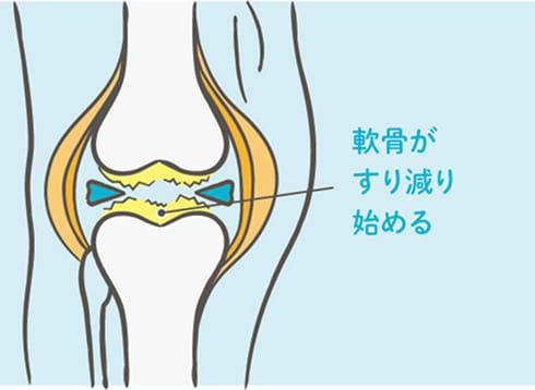 軟骨がすり始める図解