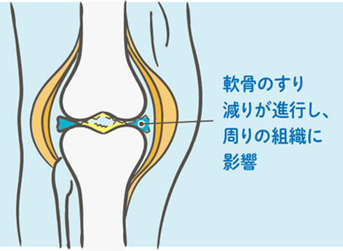軟骨のすり減りが進行し、周りの組織に影響を与える図解