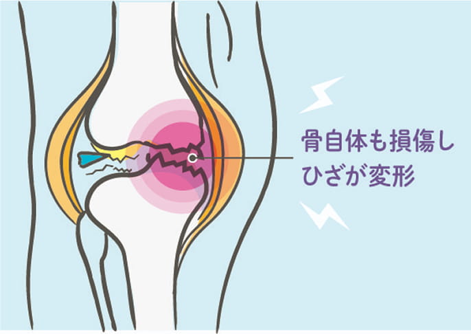 骨自体も損傷しひざが変形図解