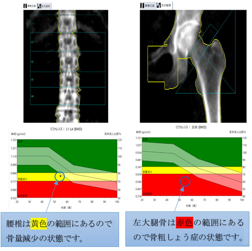 骨密度検査の結果例 腰椎は黄色の範囲になるので骨量現象の状態です。左大腿骨は赤色の範囲にあるので骨粗しょう症の状態です。