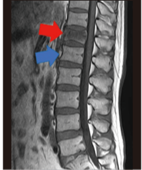 圧迫骨折 （いつの間にか骨折） MRI写真