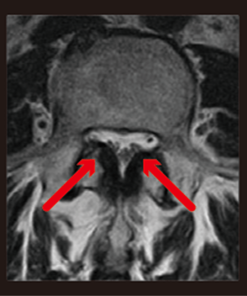脊柱管狭窄症写真