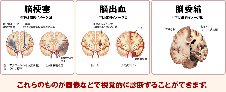 脳梗塞・脳出血・脳委縮　これらのものが画像などで視覚的に診断することができます。
